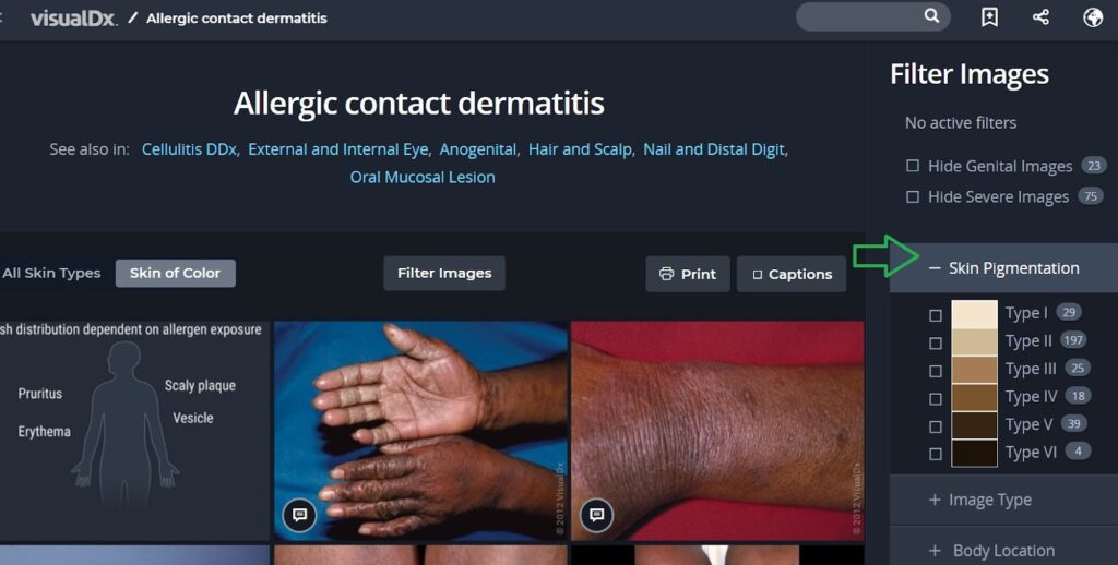 Screenshot of visual dx search results for allergic contact dermatitis with a green arrow pointing to the skin pigmentation filter.